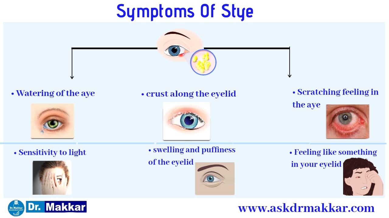 Symptoms Of Stye
